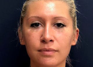 Rhinoplasty Before & After Gallery - Patient 145319 - Image 2