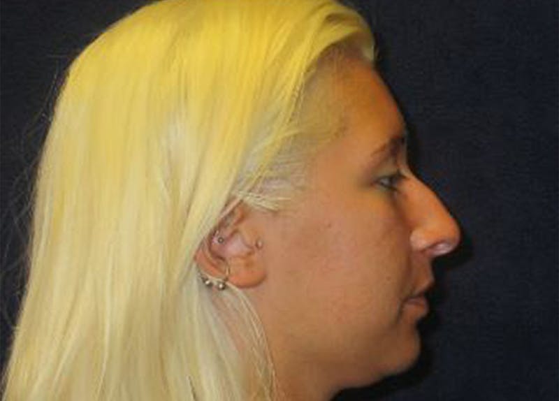 Rhinoplasty Before & After Gallery - Patient 145319 - Image 3