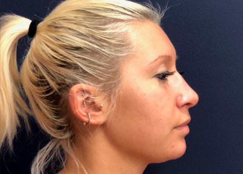 Rhinoplasty Before & After Gallery - Patient 145319 - Image 4