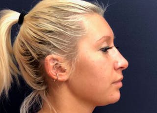 Rhinoplasty Before & After Gallery - Patient 145319 - Image 4