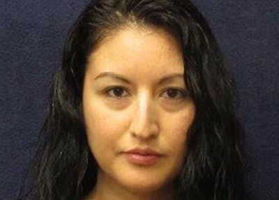 Rhinoplasty Before & After Gallery - Patient 190481 - Image 1