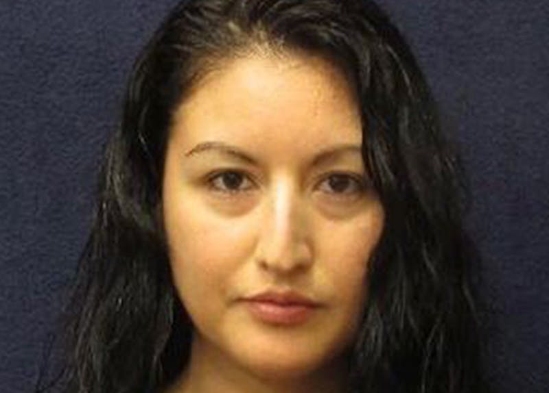 Rhinoplasty Before & After Gallery - Patient 190481 - Image 1