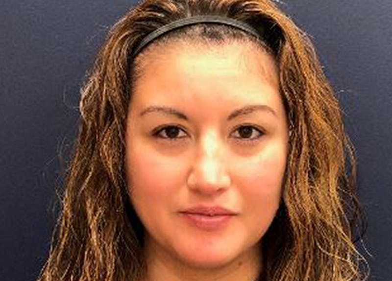 Rhinoplasty Before & After Gallery - Patient 190481 - Image 2