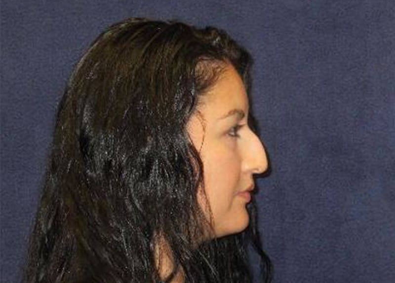 Rhinoplasty Before & After Gallery - Patient 190481 - Image 3