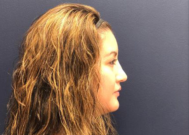Rhinoplasty Before & After Gallery - Patient 190481 - Image 4