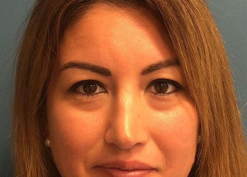 Rhinoplasty Before & After Gallery - Patient 190481 - Image 6