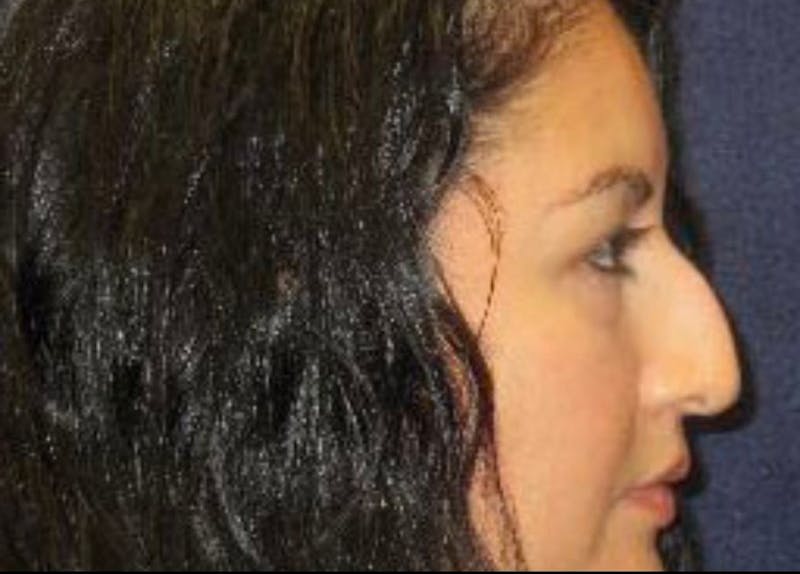 Rhinoplasty Before & After Gallery - Patient 190481 - Image 7