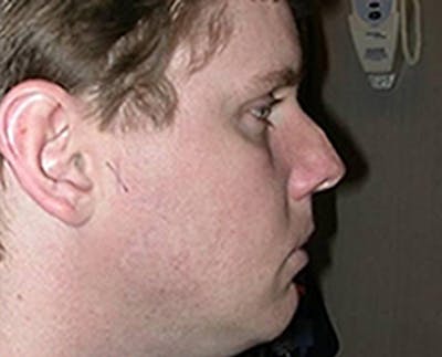 Rhinoplasty Before & After Gallery - Patient 265834 - Image 1