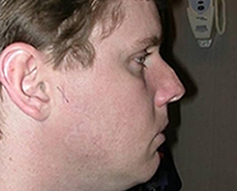 Rhinoplasty Before & After Gallery - Patient 265834 - Image 1