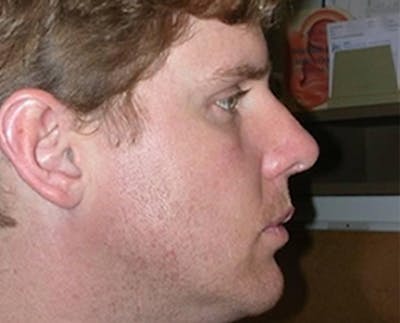 Rhinoplasty Before & After Gallery - Patient 265834 - Image 2