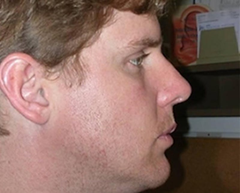 Rhinoplasty Before & After Gallery - Patient 265834 - Image 2