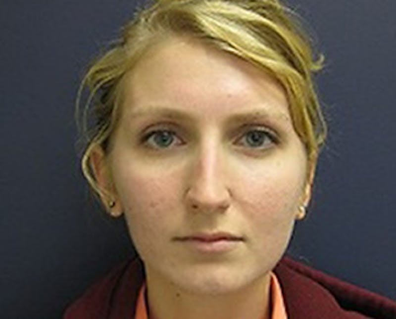 Rhinoplasty Before & After Gallery - Patient 186579 - Image 1