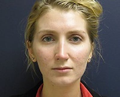 Rhinoplasty Before & After Gallery - Patient 186579 - Image 2