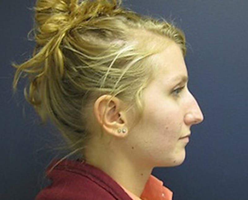 Rhinoplasty Before & After Gallery - Patient 186579 - Image 3