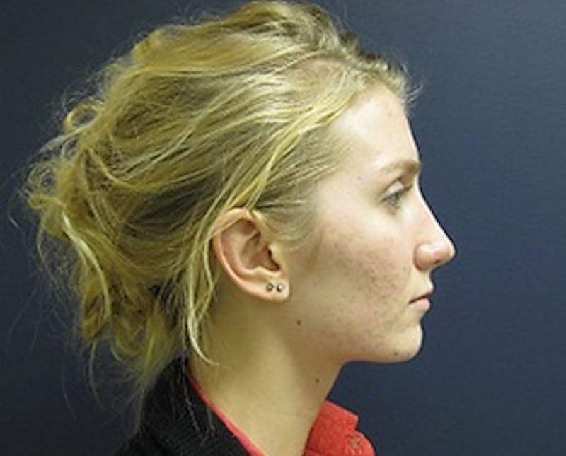 Rhinoplasty Before & After Gallery - Patient 186579 - Image 4