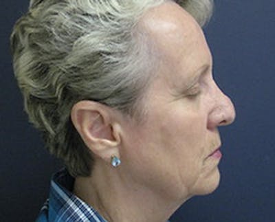 Rhinoplasty Before & After Gallery - Patient 212790 - Image 1