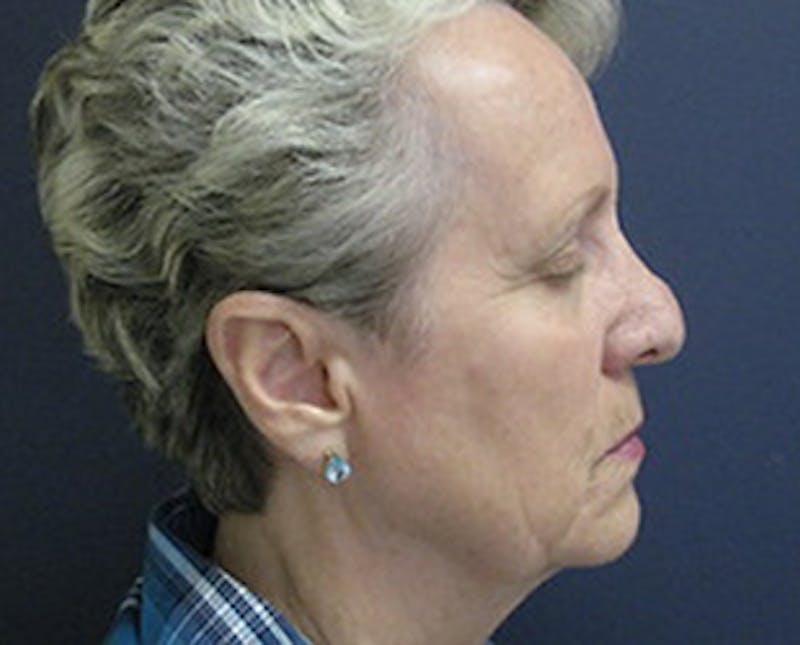 Rhinoplasty Before & After Gallery - Patient 212790 - Image 1