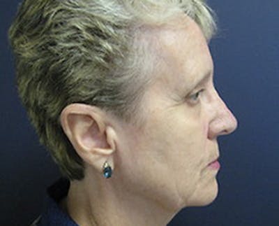 Rhinoplasty Before & After Gallery - Patient 212790 - Image 2