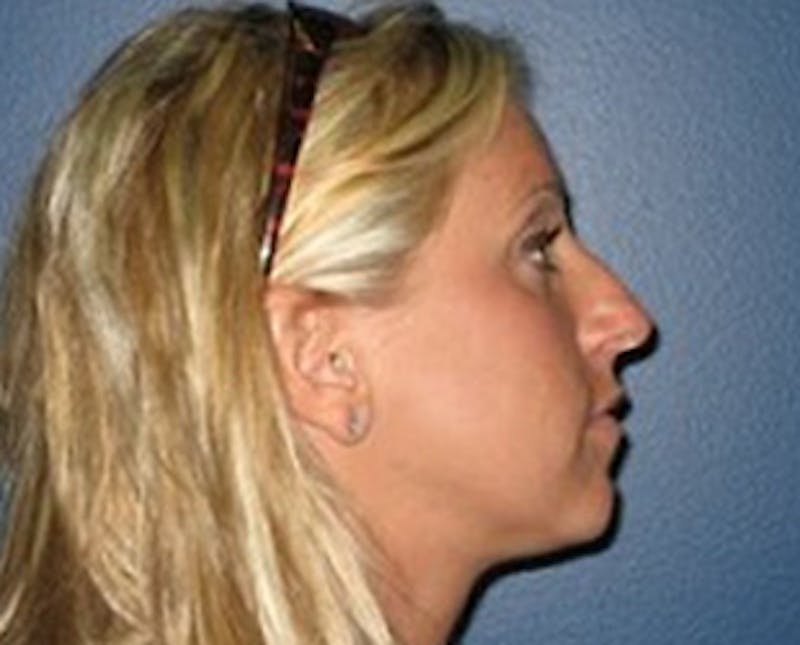 Rhinoplasty Before & After Gallery - Patient 272948 - Image 1