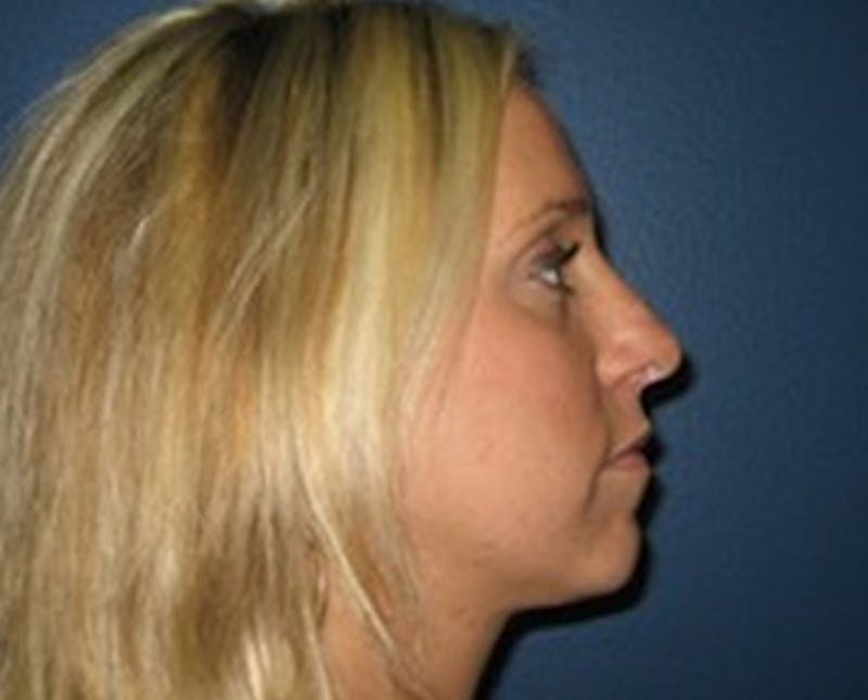 Rhinoplasty Before & After Gallery - Patient 272948 - Image 2