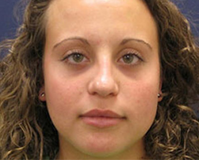Rhinoplasty Before & After Gallery - Patient 179342 - Image 1
