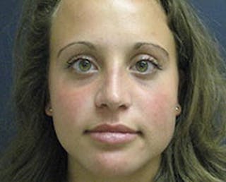 Rhinoplasty Before & After Gallery - Patient 179342 - Image 2