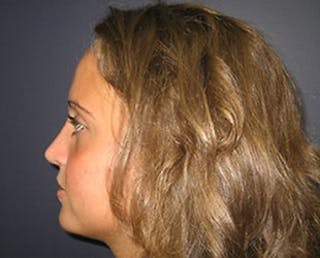 Rhinoplasty Before & After Gallery - Patient 179342 - Image 4