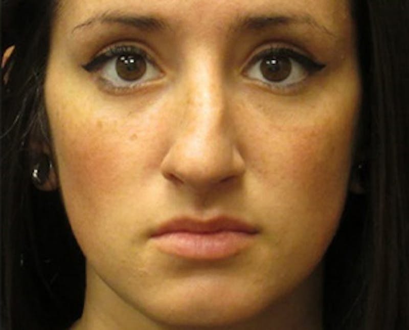 Rhinoplasty Before & After Gallery - Patient 118848 - Image 1