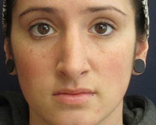 Rhinoplasty Before & After Gallery - Patient 118848 - Image 2