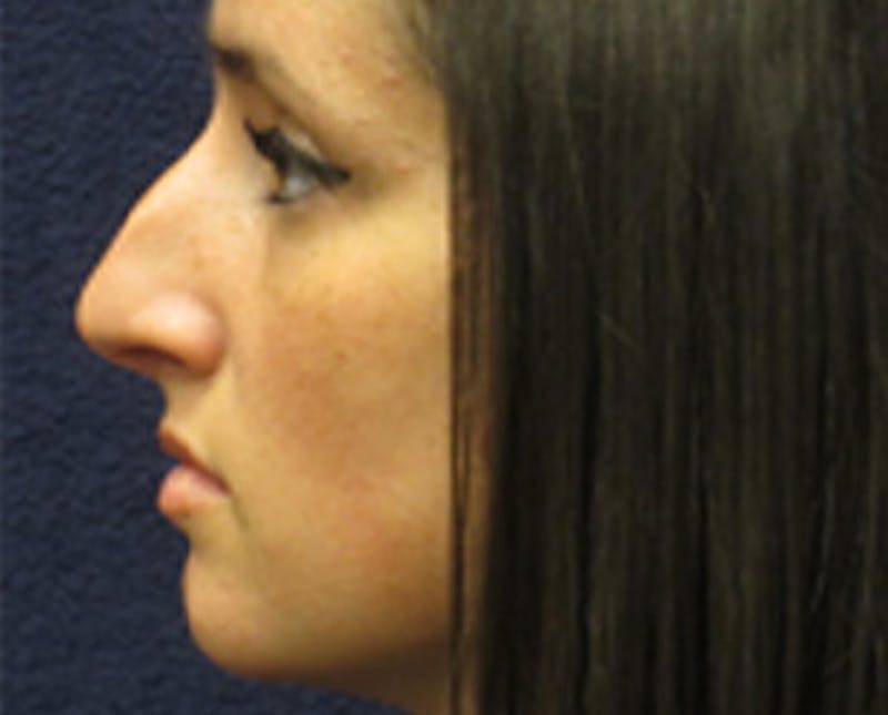 Rhinoplasty Before & After Gallery - Patient 118848 - Image 3