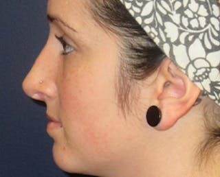 Rhinoplasty Before & After Gallery - Patient 118848 - Image 4