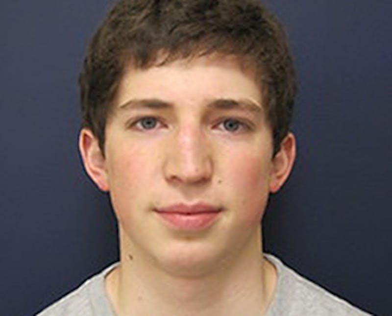 Rhinoplasty Before & After Gallery - Patient 118649 - Image 1