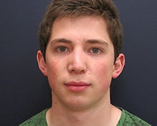 Rhinoplasty Before & After Gallery - Patient 118649 - Image 2