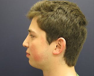 Rhinoplasty Before & After Gallery - Patient 118649 - Image 4
