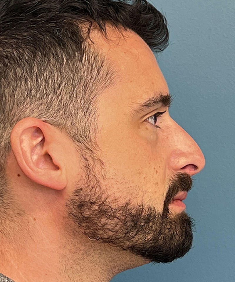 Rhinoplasty Before & After Gallery - Patient 977289 - Image 3