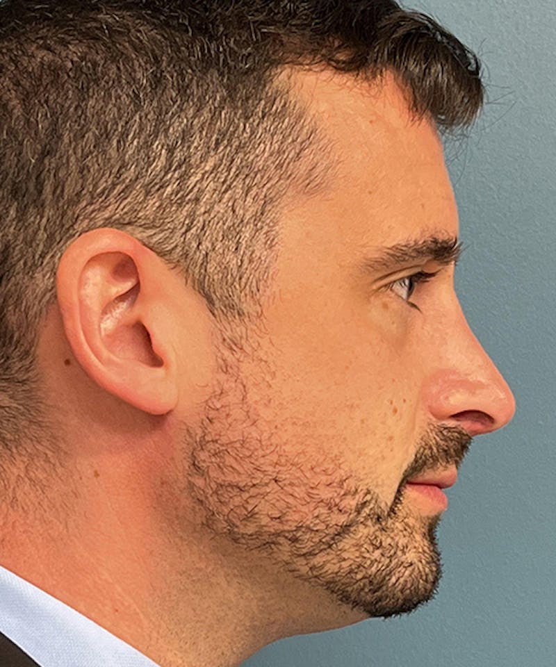Rhinoplasty Before & After Gallery - Patient 977289 - Image 4