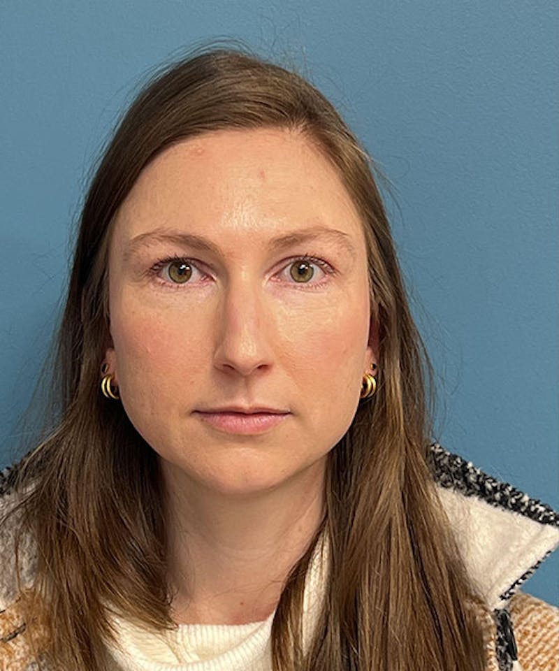 Rhinoplasty Before & After Gallery - Patient 207610 - Image 1
