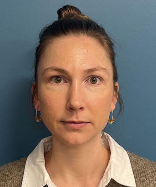 Rhinoplasty Before & After Gallery - Patient 207610 - Image 2