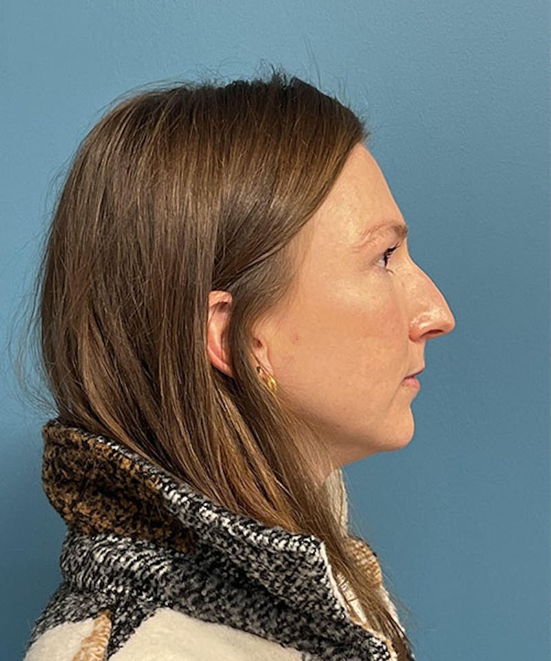 Rhinoplasty Before & After Gallery - Patient 207610 - Image 3