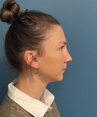 Rhinoplasty Before & After Gallery - Patient 207610 - Image 4