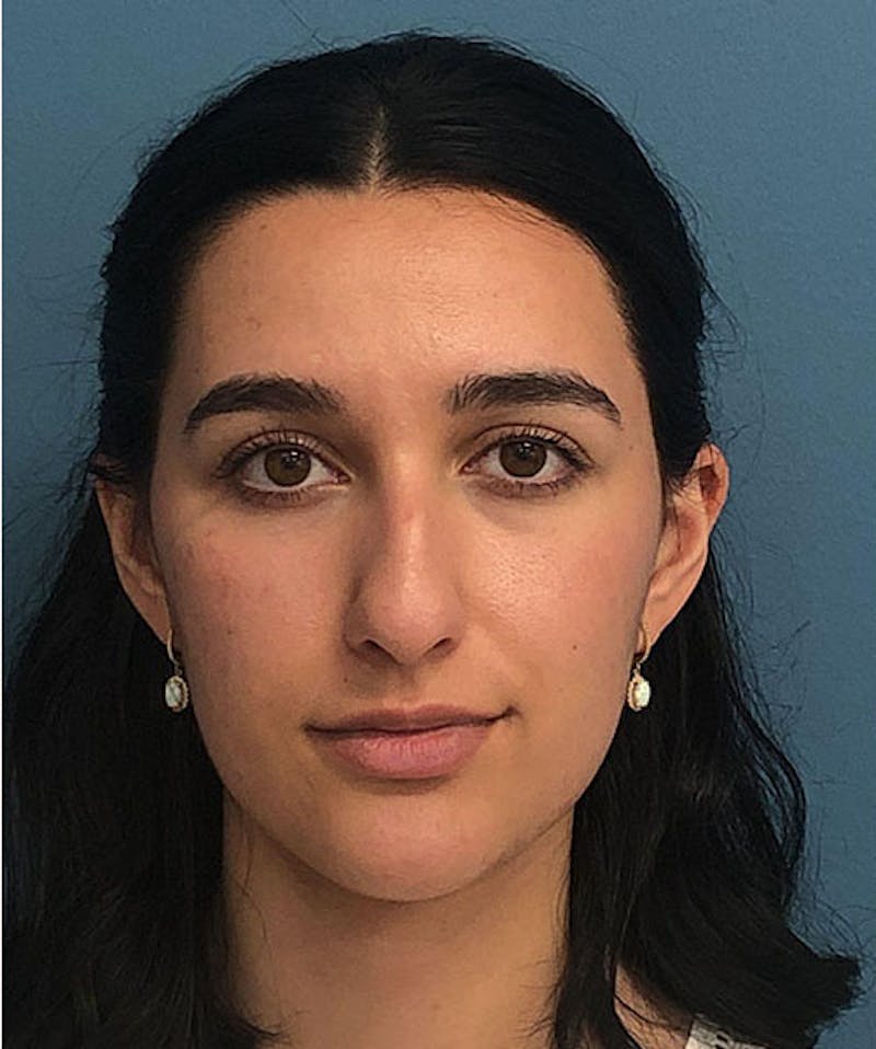 Rhinoplasty Before & After Gallery - Patient 332137 - Image 1