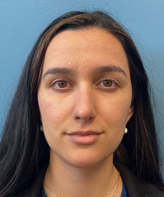 Rhinoplasty Before & After Gallery - Patient 332137 - Image 2
