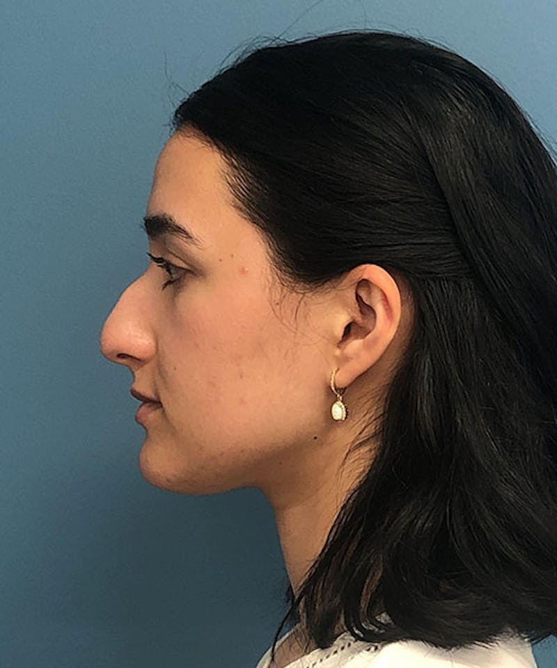 Rhinoplasty Before & After Gallery - Patient 332137 - Image 3