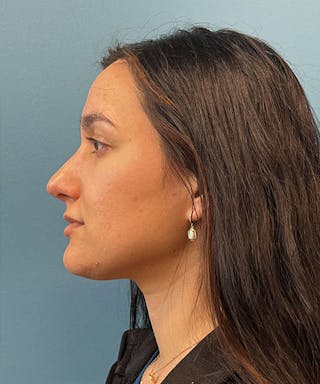 Rhinoplasty Before & After Gallery - Patient 332137 - Image 4