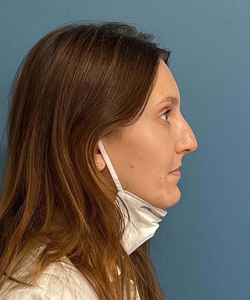 Rhinoplasty Before & After Gallery - Patient 173835 - Image 1