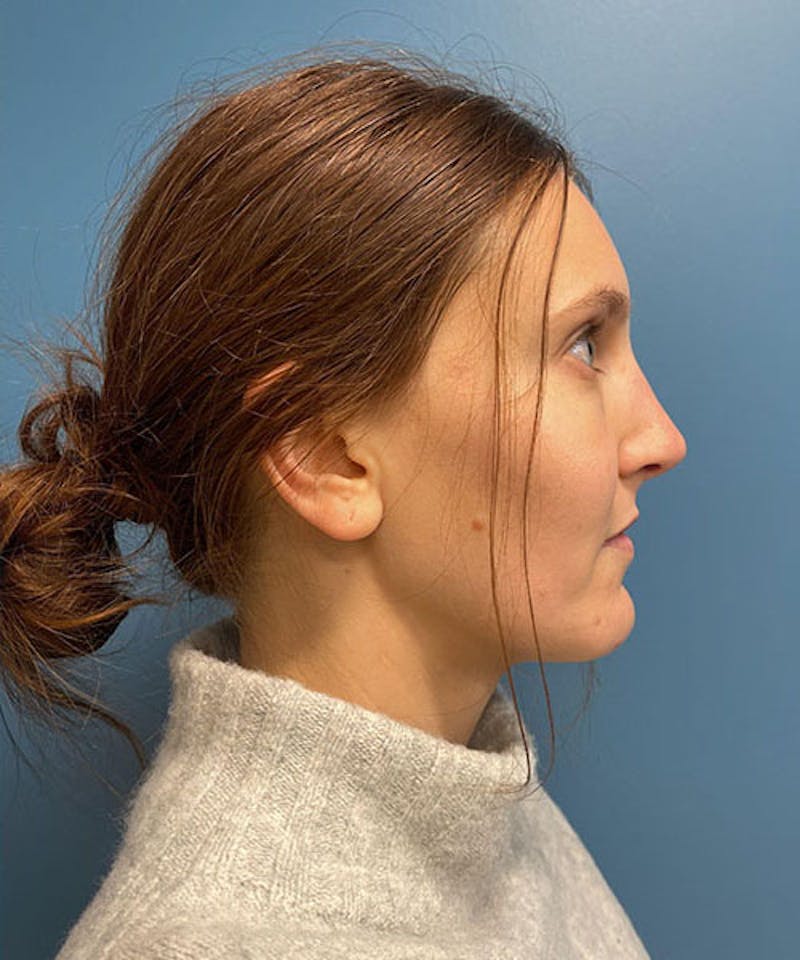 Rhinoplasty Before & After Gallery - Patient 173835 - Image 2