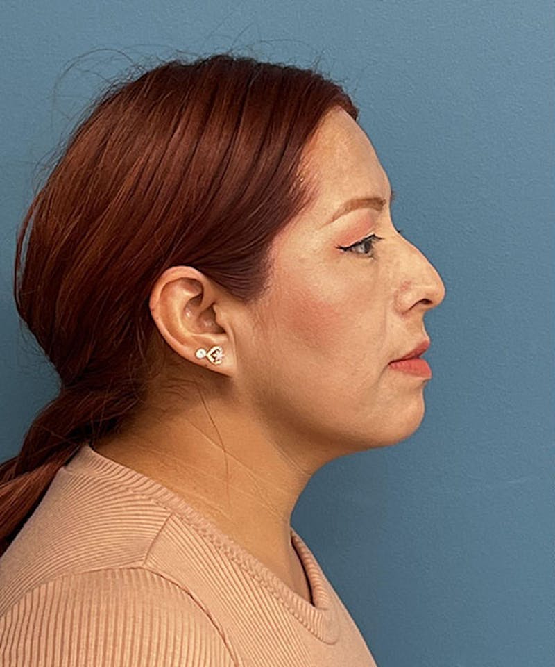 Rhinoplasty Before & After Gallery - Patient 502103 - Image 1