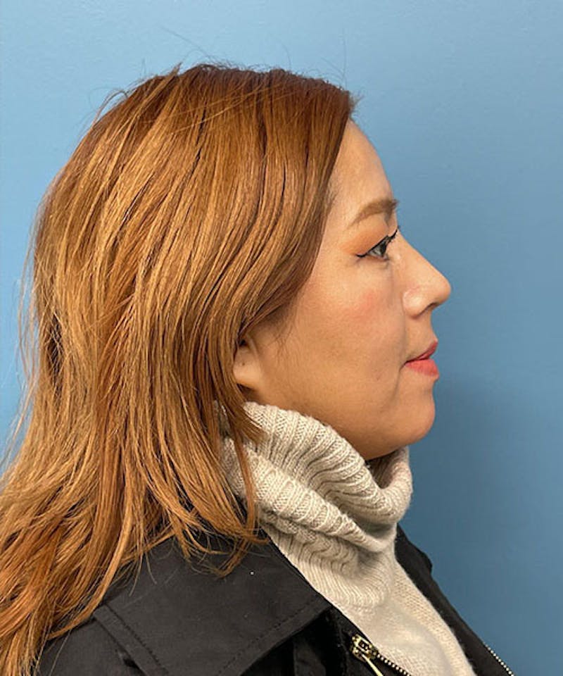 Rhinoplasty Before & After Gallery - Patient 502103 - Image 2