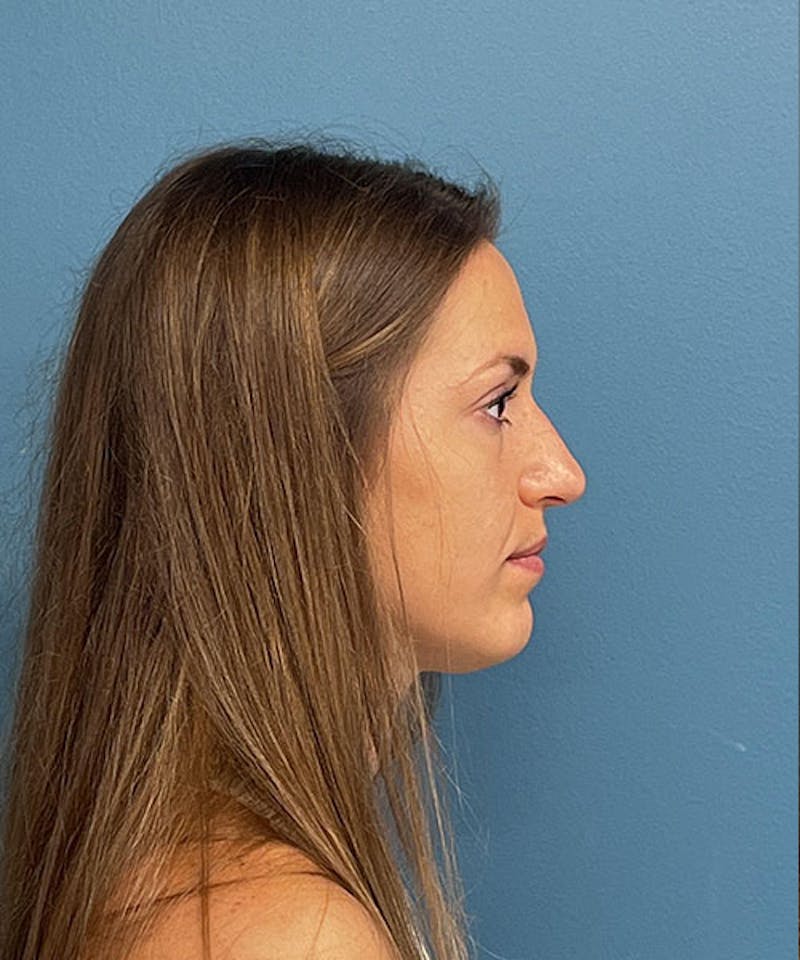 Rhinoplasty Before & After Gallery - Patient 353366 - Image 1