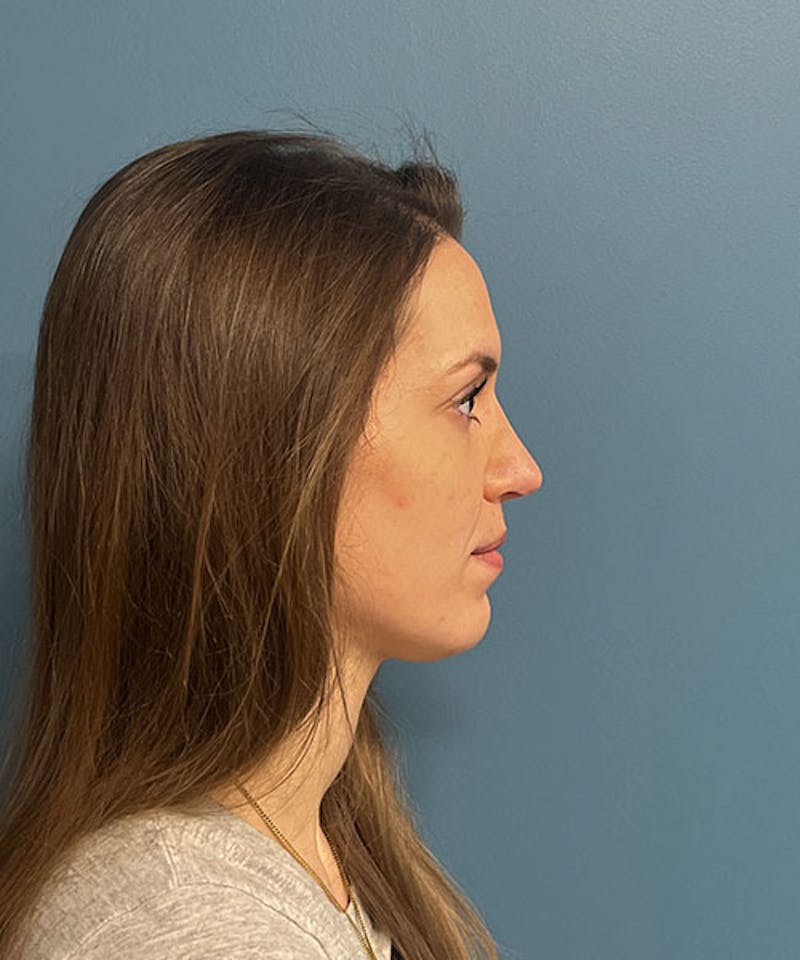 Rhinoplasty Before & After Gallery - Patient 353366 - Image 2